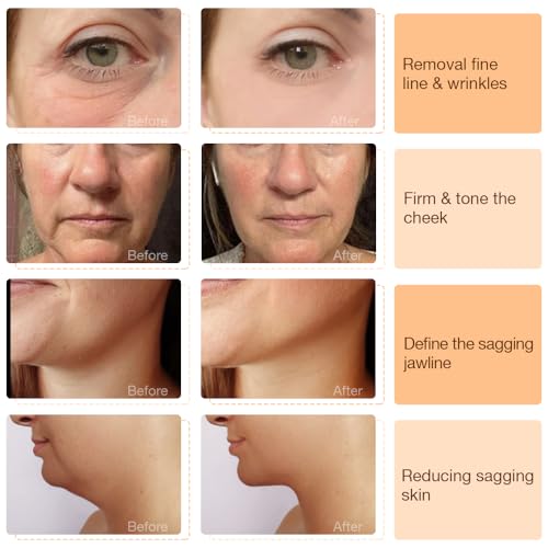 ALUSHEE 6-in-1 RF Face Tightening Device | Lifting & Anti-Aging