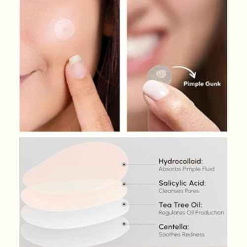 Clear Pimple Patches ? 72 Ct Hydrocolloid Acne Patches w/ Salicylic Acid & Tea Tree Oil ? Fast-Acting Zit Stickers for Face, Blemish & Spot Treatment ? Invisible, Waterproof & Gentle for All Skin