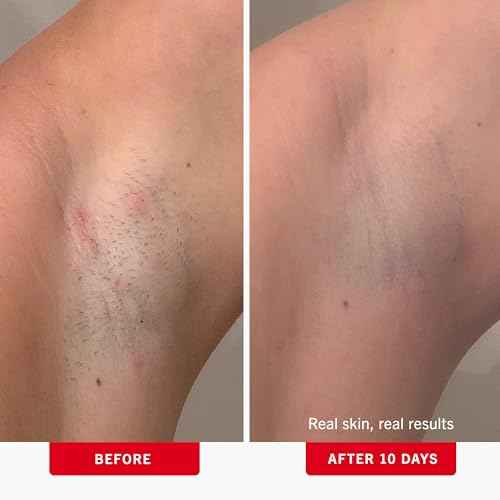 First Aid Beauty - Ingrown Hair Pads with BHA + AHA - Aftershave Treatment Pads to Help Prevent Razor Bumps for Men & Women - Exfoliate Underarms & Bikini Area - Compostable for Daily Use - 28 Pads