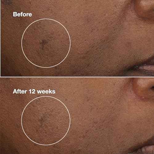 Clinique Even Better Clinical Brightening Moisturizer With Salicylic Acid, Glucosamine + Vitamin C | Hydrating + Dark Spot Reducing