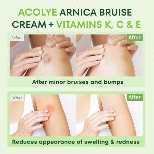 Arnica Cream for Bruising and Swelling: Extra Strength Arnica Bruise Cream with Vitamins K C E for Seniors Aged 55 and Above - Fast Healing Formula Ideal for Thin Skin 3.5 oz