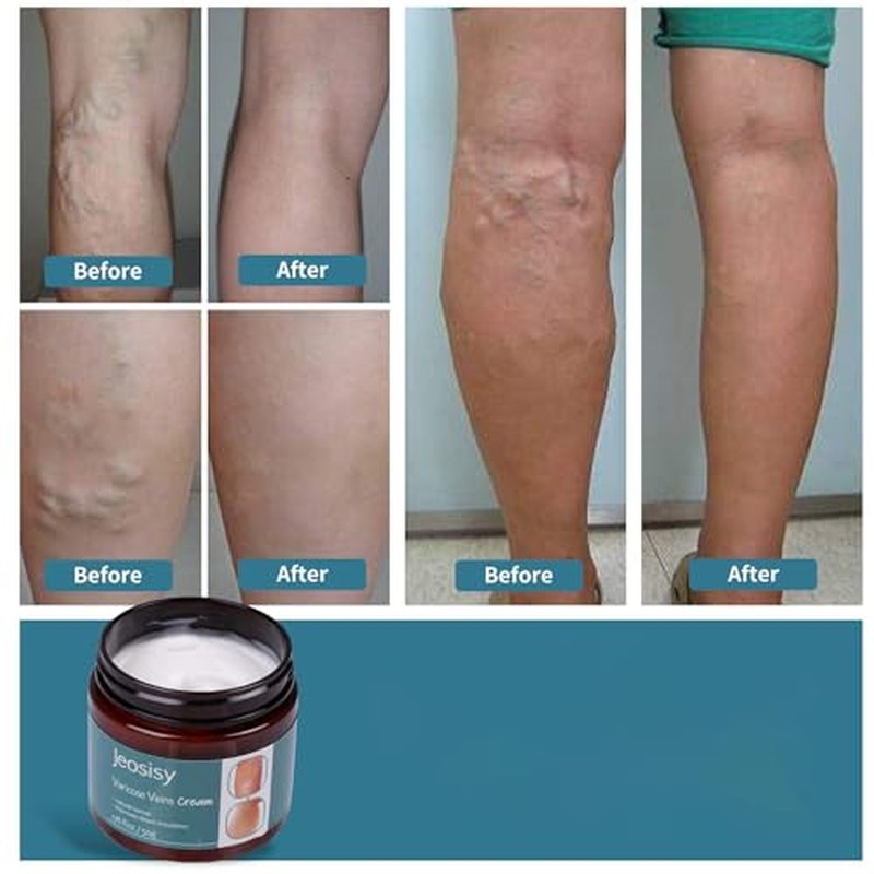 Natural Varicose Vein Cream for Soothing Legs & Skin