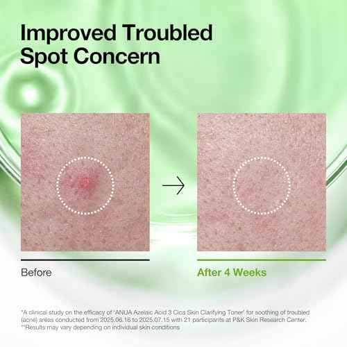 Anua Azelaic Acid 3 CICA Skin Claryfing Toner, Soothing & Clear Care, with Salicylic Acid & Azelaic Acid, Sebum & Spot Care, Suitable for Sensitive Skin, Korean Skin Care (250ml / 8.45 fl.oz.)