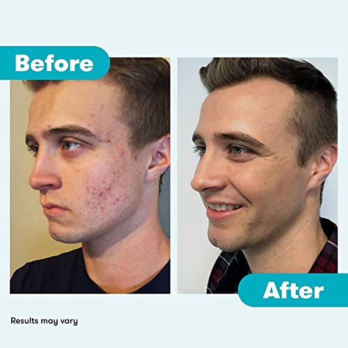 Proactiv Acne Cleanser - Benzoyl Peroxide Face Wash and Acne Treatment - Daily Facial Cleanser and Hyularonic Acid Moisturizer with Exfoliating Beads - 90 Day Supply, 6 Fl Oz