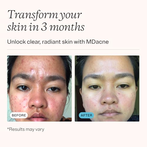 MDacne 3-Step Acne Treatment Kit with Benzoyl Peroxide