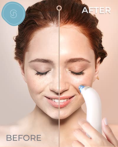 Essy Blackhead Remover Pore Vacuum - 5 Level Suction