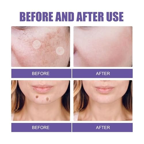 Dark Spot Remover Dissolving Micropoints - 144pc