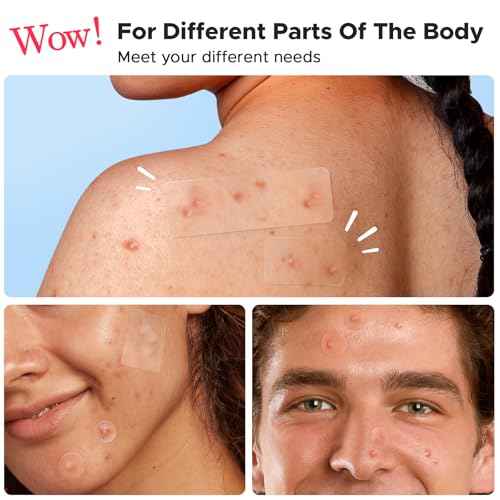 LitBear Large Pimple Patches, 5 Sizes 156 Patches Big Acne Patch, 60 XL Hydrocolloid Patch for Full Face, Forehead, Chin, Nose, Body, Back, Neck & Chest, Stirp, Square Large Hydrocolloid Bandages