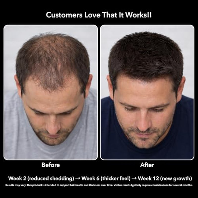 DHT Blocker for Men with 10000mcg Biotin & Saw Palmetto