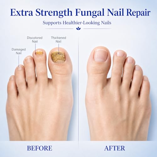 Toenail Fungus Treatment Pen with 25% Undecylenic Acid - 4 Pack