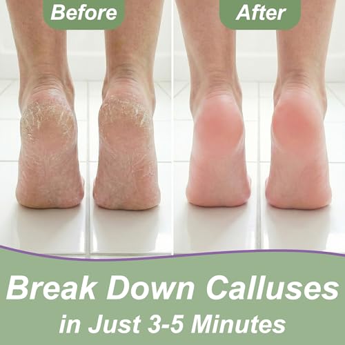 EntreFeet Extra Strength Foot Callus Remover Gel Kit with Stainless File - 4 oz