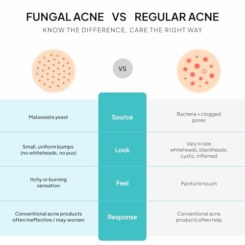 Fungal Acne Treatment Lotion: Helps with Bumps, Clusters, Itch & Redness ? Lightweight Anti-Fungal Face & Body Moisturizer for Fungal Skin with Natural Actives & Soothing Plant Extracts