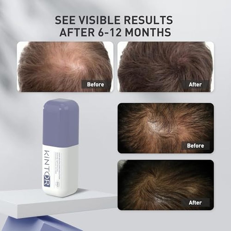 KINTOR Hair Growth Spray for Men - DHT Blocker & Oil Control, 60ml