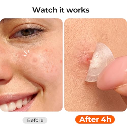 TKTK Pimple Patches for Face, 0.01cm Ultra-Thin Invisible Acne Patches, Hydrocolloid Patches for Breakouts, Absorbs Zits & Blemish, Suitable Under Makeup, 2 Sizes(10mm/12mm) 264 count