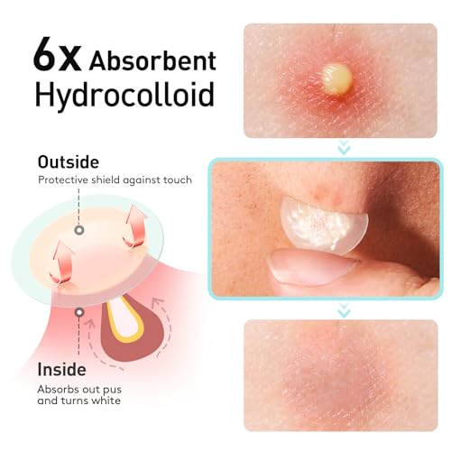 TKTK Pimple Patches, 12 mm Invisible Acne Patches for Face with Salicylic Acid, 0.01cm Extra Thin Outer Edge, Hydrocolloid Zit Patch for Pustule, Whitehead, Cystic Acne Spot, 48 Count