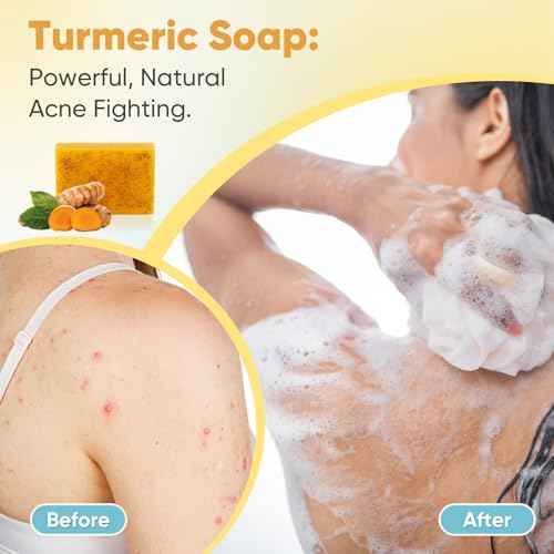 Treeroot 5 Pack Turmeric Soap for Dark Spots, 80g Kojic Acid and Turmeric Soap Bar, Face Even Skin Tone, Natural Potent Moisturizing Ingredient, Contains Vitamin C, Shea Butter, Lemon Oil, Retinol