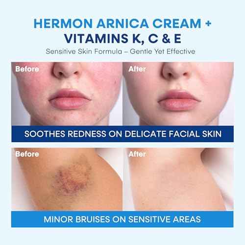 Hermon Arnica Bruise Cream with Vitamin K: Sensitive Skin & Face Formula for Bruising, Swelling & Thin Skin ? Extra Strength Arnica Montana Hydrating Moisturizer 2 Oz