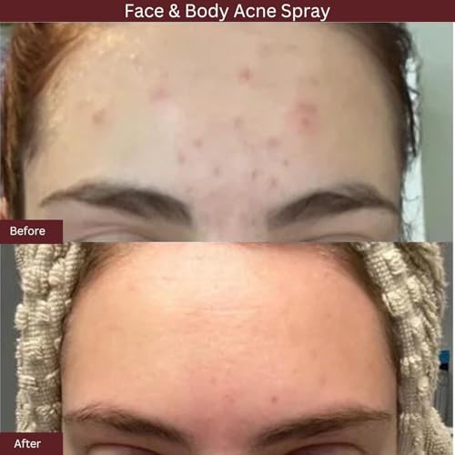 ITK Skincare 2% Salicylic Acid Spray for Face & Body Acne - Blemish-Fighting Treatment for Body Acne, Bacne, Blackheads, Pimples & Blemishes - BHA Blemish Facial Mist Post Workout - 3.3oz Spray Bottle