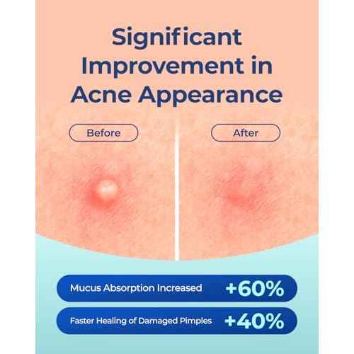 POINTMASS Pimple Patches for Face Acne: Invisible 0.1mm Ultra-Thin Hydrocolloid Zit Stickers with Tea Tree Oil - 44 Dots, 2 Sizes (Whiteheads/Sensitive Skin)