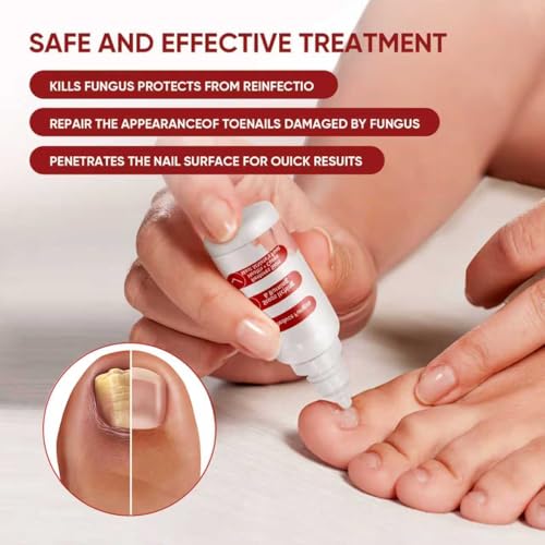 Toenail Treatment,Gentle Formula, Effectively Improves Nails for a