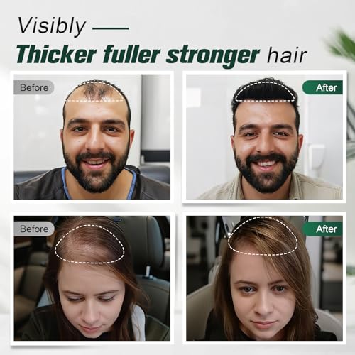 5% Minoxidil & Keratin Hair Growth Shampoo for Thinning Hair