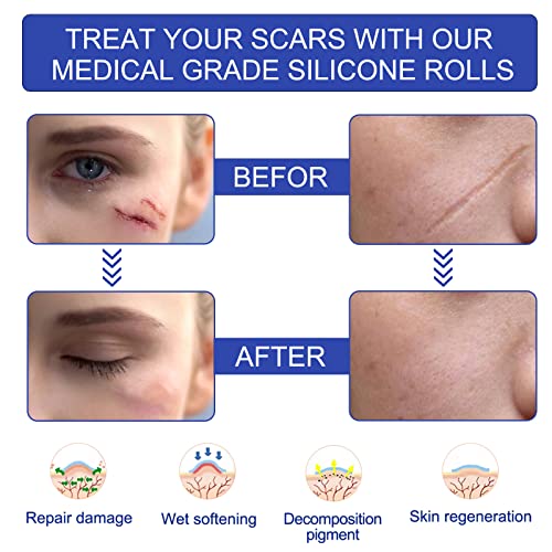 New Transparent Silicone Scar Sheets(1.6¡± x 120¡±Inch - 3M),Away Scar Tape,Scar Strips, Reusable, Professional Scar Removal Sheets for C-Section, Surgery, Burn, Keloid, Acne et, Scar Patch.