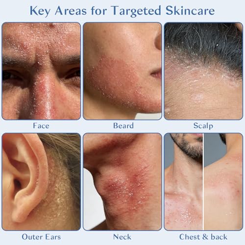 Seborrheic Dermatitis Cream for Face & Scalp - Nourishing Moisturizer with Azelaic Acid & Niacinamide