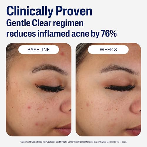 Cetaphil Gentle Clear Mattifying Acne Moisturizer, 3oz