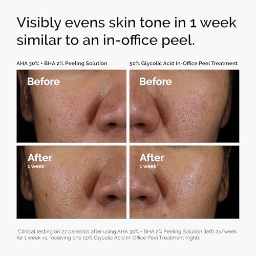 The Ordinary AHA 30% + BHA 2% Peeling Solution
