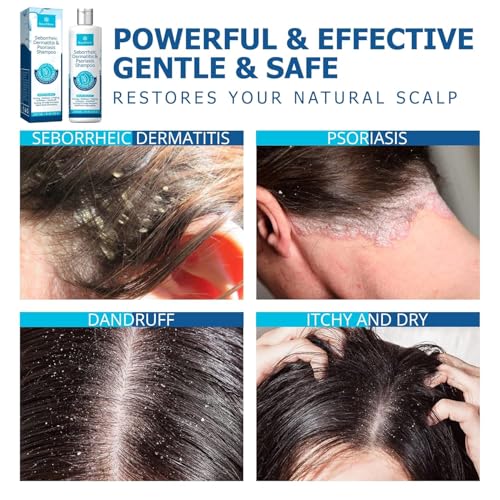 Roycederm Seborrheic Dermatitis & Psoriasis Shampoo