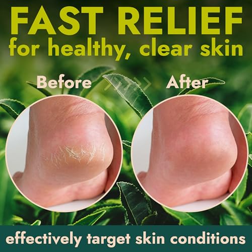 Professional Callus Remover Gel with Tea Tree Oil - 14 fl oz