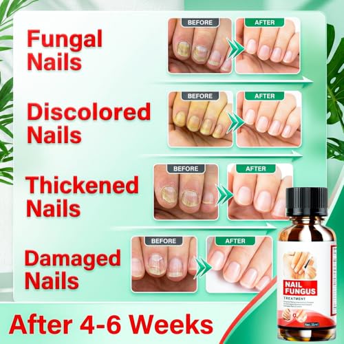 Chamex Extra Strength Toenail Fungus Treatment with Natural Extracts