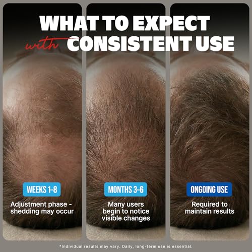 Kirkland Minoxidil 5% Men's Hair Regrowth Treatment, 6-Month Supply
