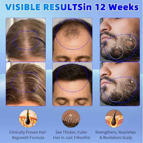 Minoxidil for Men and Women Hair Growth: 5% Minoxidil Spray Hair Regrowth Treatment Serum Stop Hair Thinning and Hair Loss For Stronger Thicker Longer Hair