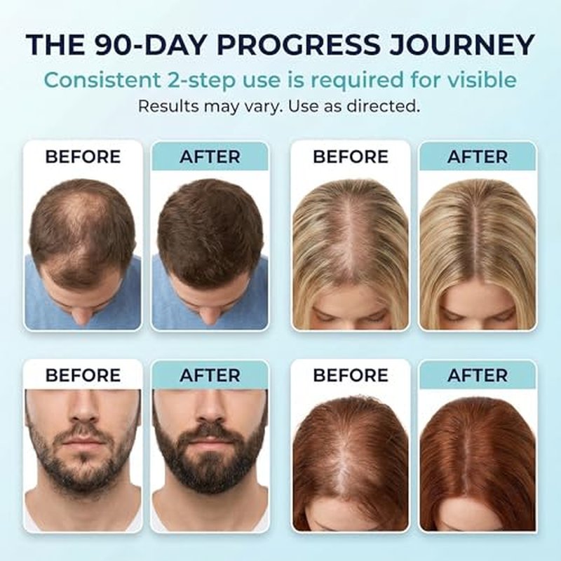 5% Minoxidil Foam for Men & Women - 2-Pack 1oz Cans