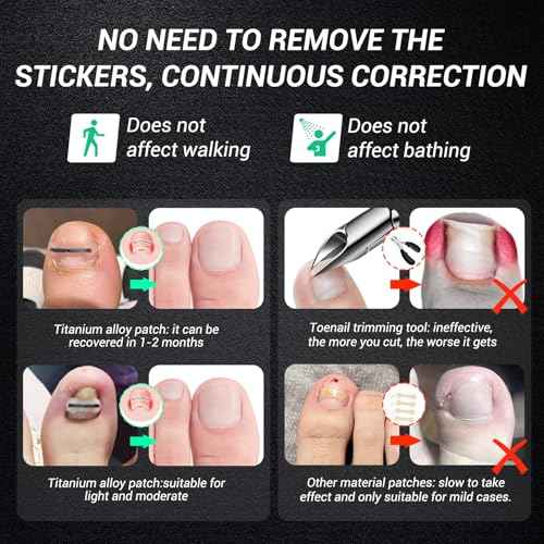 Titanium Alloy Ingrown Toenail Treatment, Nail Tools, and Ingrown Toenail Removal Kit Specially Designed for Curved Nail Repair and Ingrown Toenail Corrector (0.67/0.79in)