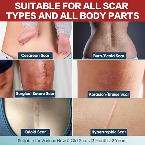 1.6¡±x240¡±Roll Medical Grade Silicone Scar Sheets, Reusable Silicone Scar Tapes for Surgical, C-Section, Tummy Tuck, Keloid Scars- Easy to cut