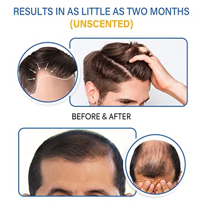 5% Minoxidil Foam for Men & Women Hair Regrowth