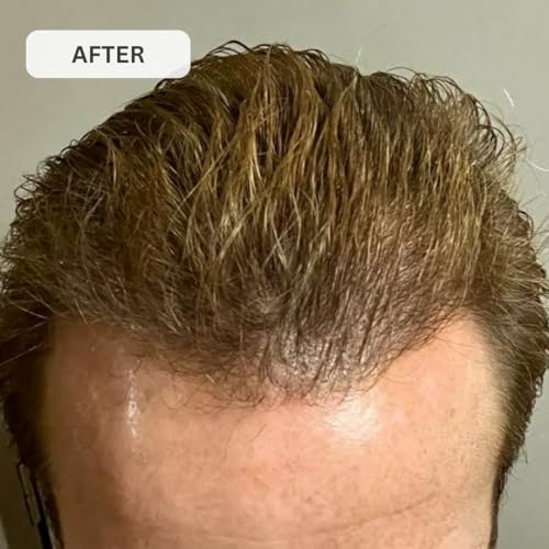 Kiierr 272 MD Laser Cap | FDA-Cleared Hair Loss Treatment