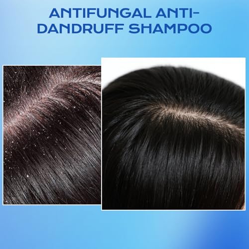 FYZMTL 1% Ketoconazole Anti-Dandruff Shampoo 6.75 Fl Oz Scalp Treatment for Itchy Flakes