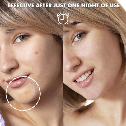 Large Acne Pimple Patches for Face, Chin, Back and Body (10 Counts), Spot Dots Cover by Albatross Health New England, Hydrocolloid Treatment Stickers, Zit Blemish Patch