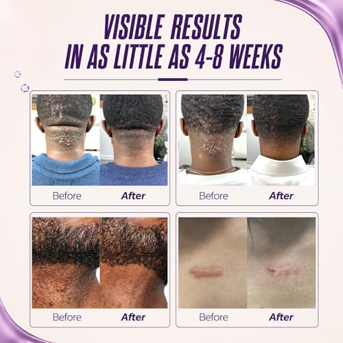 ABERA Kelo Scar Cream – Razor Bump & AKN Treatment for Men