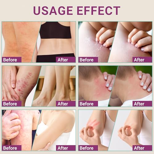 LMNOOP Anti Itch Cream - Extra Strength Relief for Eczema & Rash
