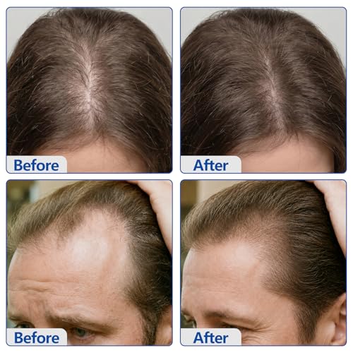 5% Minoxidil Hair Growth Cream for Men & Women - Non-Greasy 3.5oz