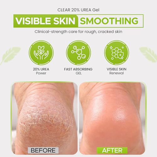 CLEAR 20 Urea Gel 4 oz - Callus & Cracked Heel Remover