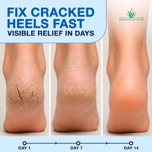 Miracle of Aloe Cracked Heel Balm Stick for Dry Feet - 2.5 oz Twist-Up