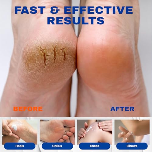 SKIN ULTIMA 40% Urea Cream with 2% Salicylic Acid for Dry Cracked Feet, 5.29 oz