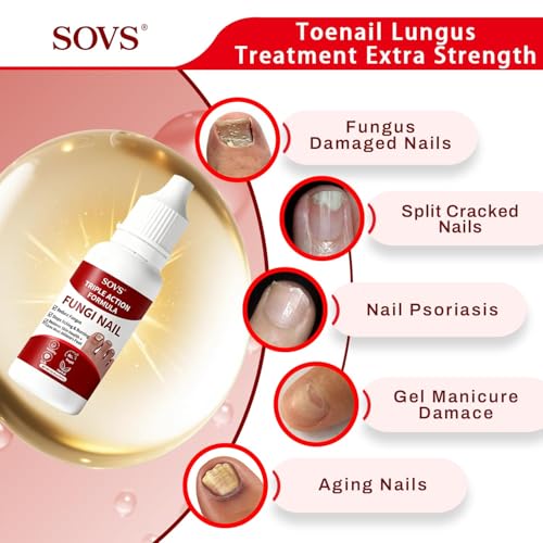 SOVS Toenail Treatment Liquid - Nail Care Solution