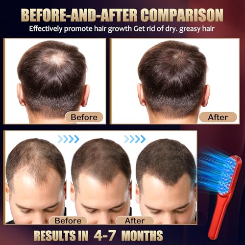 Laser Hair Growth Comb - Red Light Treatment for Men & Women