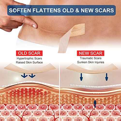 Silicone Scar Sheets Tape for Surgical Scars, C Section Scar Silicone Strips, Medical Grade, Reusable, Soften and Flattens Scars, Breast, Keloid, Professional Scar Patches. (1.8x157 Inch)